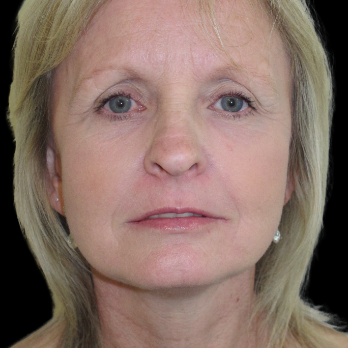 Front view of patient after Breast Augmentation Surgery
